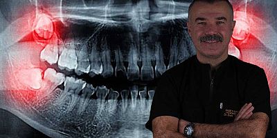 Yirmilik Dişler İhmale Gelmiyor! Uzmanı Uyardı: Gülüşünüz Bozulabilir